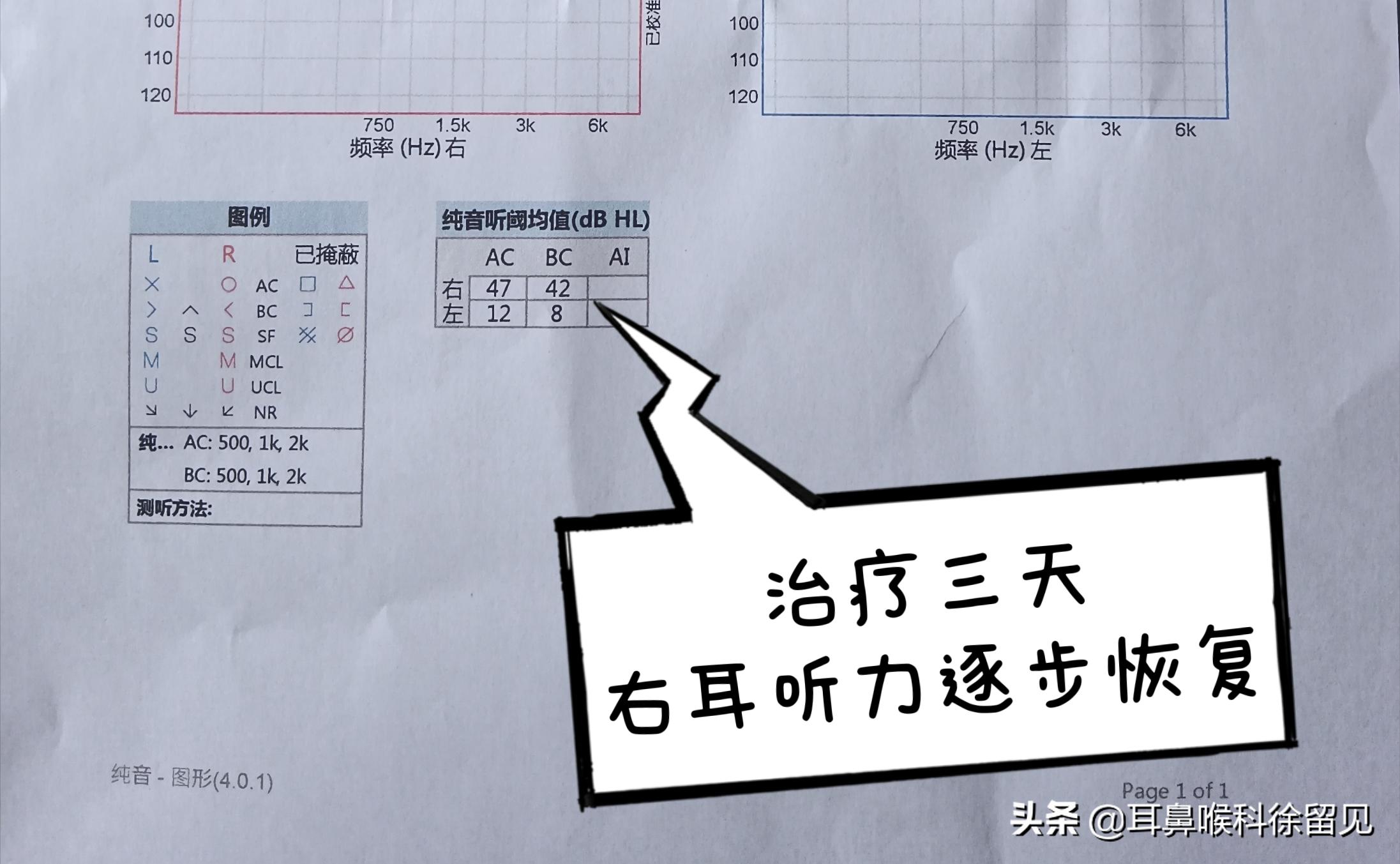 年轻女孩K歌后患上突发性耳聋,花了1周的时间做治疗