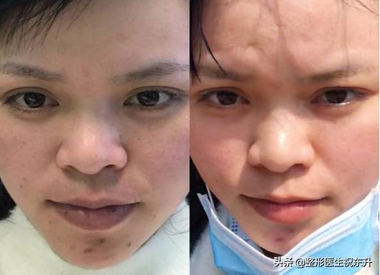 马上要回家过年了，给你们推荐一个能短期变美的整容项目：水光针