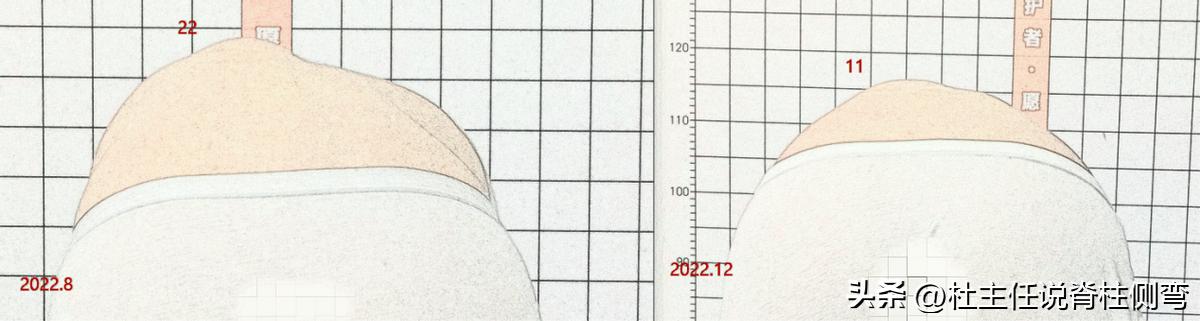 S型脊柱侧弯，一定要戴长支具矫形吗？此文告知您