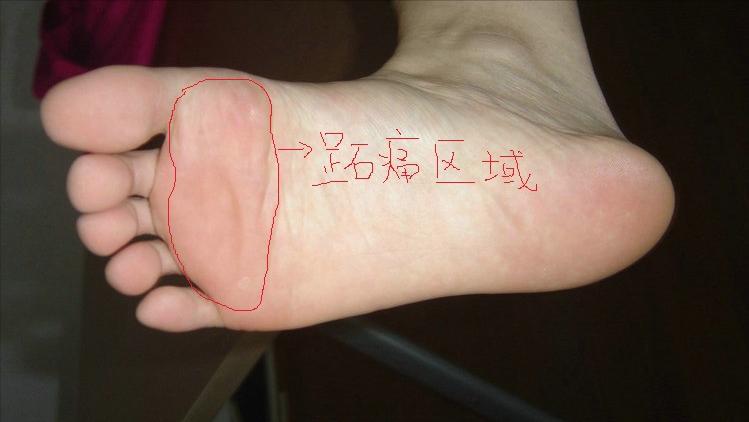 脚底板爱发烫是什么原因,脚底板生茧很疼怎么回事