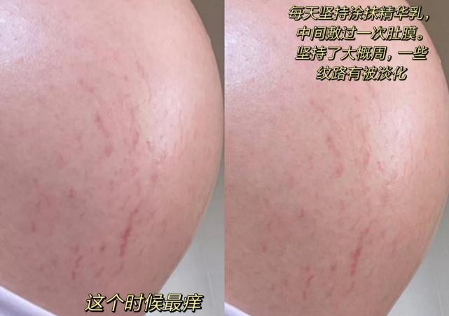 怀孕期间长了妊娠纹怎么补救,怀孕长妊娠纹怎么消除