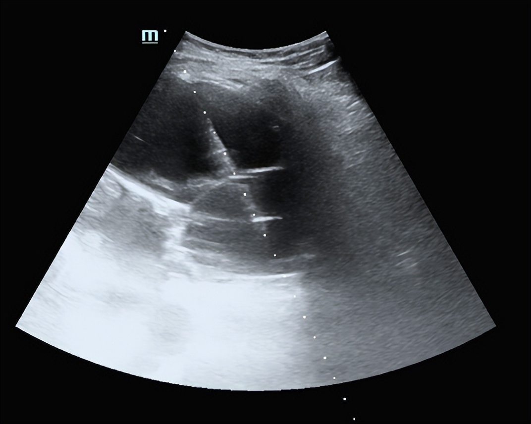 专家讲解多发肝囊肿治疗视频,多发性肝囊肿适合什么手术
