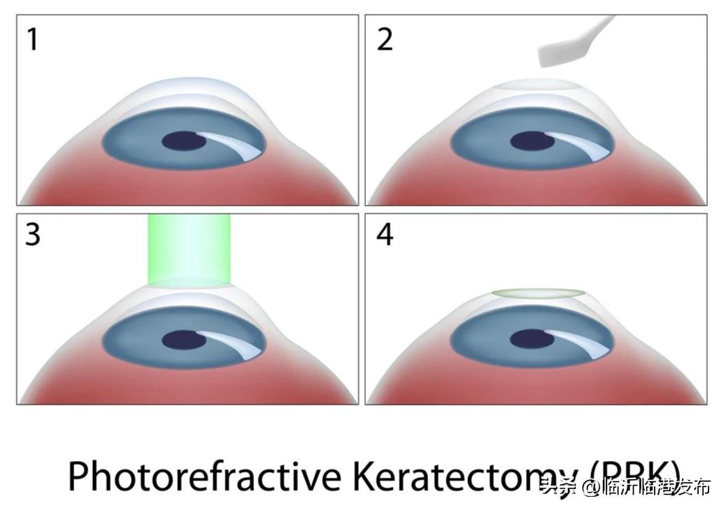 激光手术后视力反弹,激光近视手术做后视力有多少
