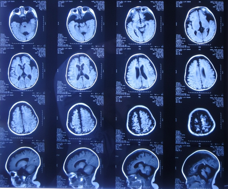 蛛网膜囊肿合并脑积水腹腔分流术,治疗蛛网膜囊肿引起脑积水严重吗