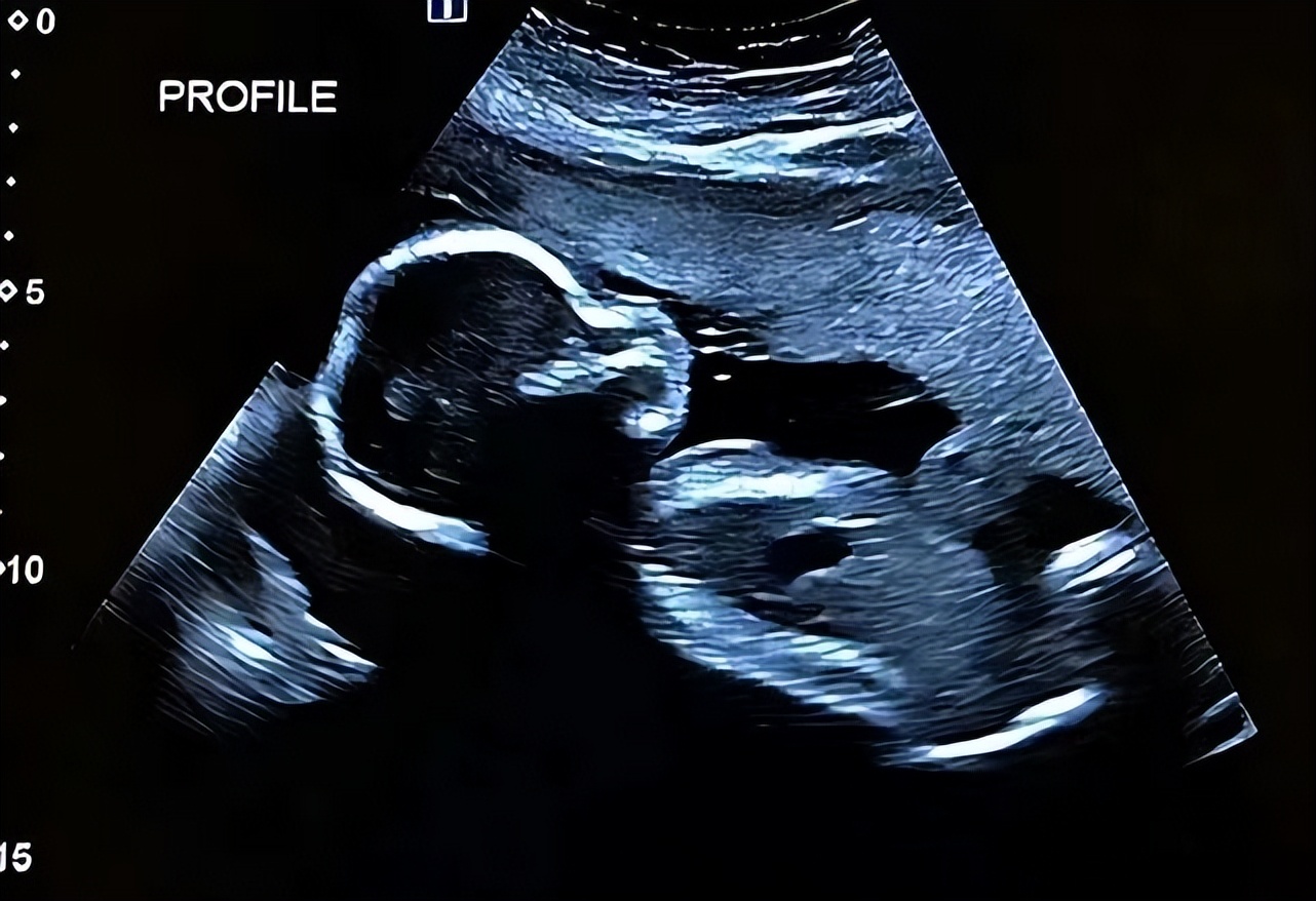 袖珍女孩梁小小出生日期,袖珍女孩梁小小现在长大的样子