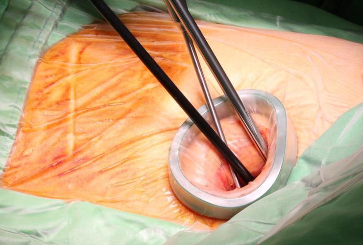 全胸腔镜下，与右侧开胸小切口房间隔缺损修补术的临床结果分析