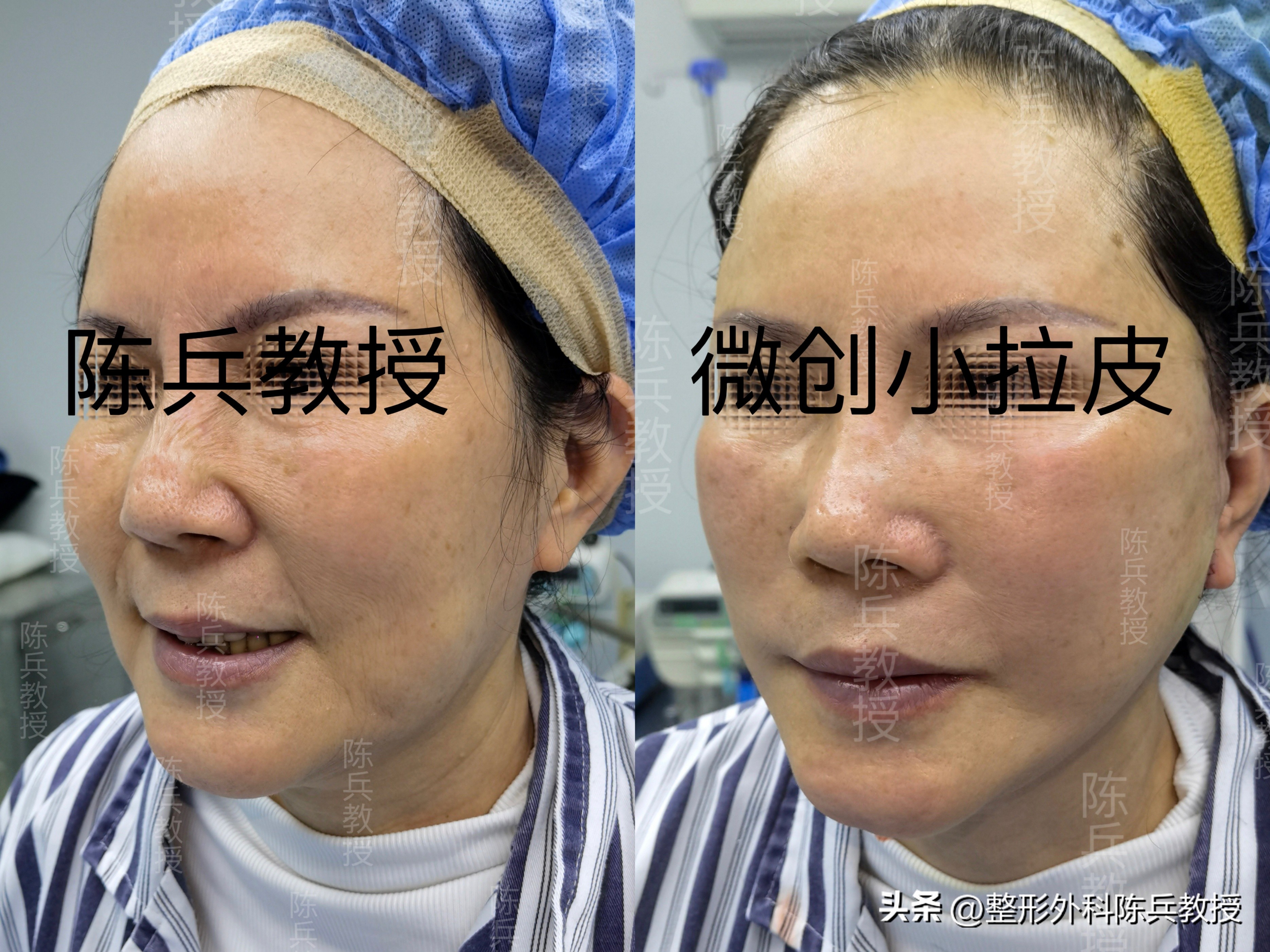 大拉皮和小拉皮哪个效果好,大拉皮跟小拉皮的区别是什么