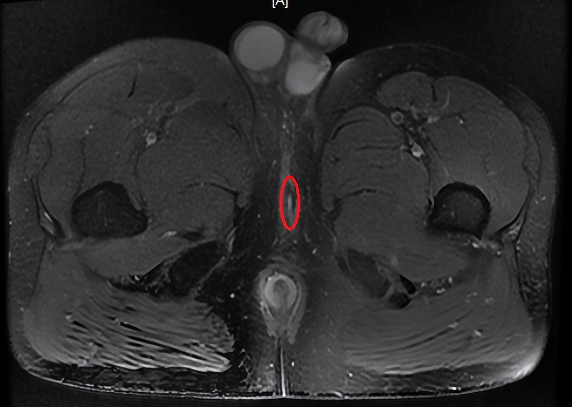 为什么有些人肛瘘一个星期就好了,为什么有的肛瘘术后不需要换药