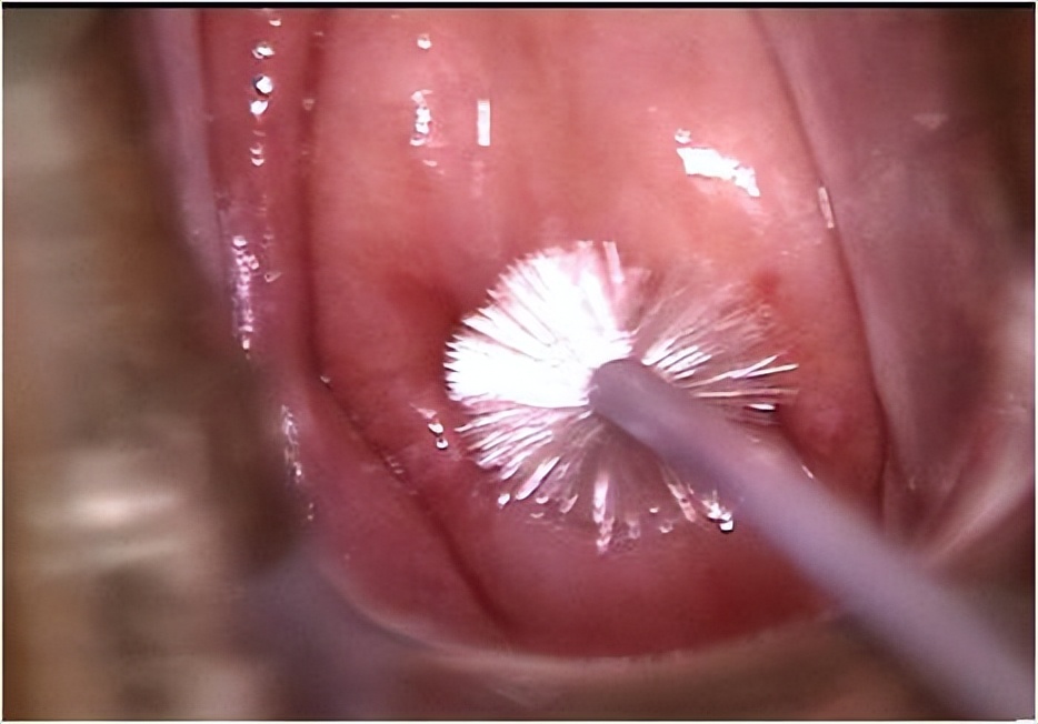 宫颈癌的4个常识,宫颈癌很可怕三个步骤教你预防
