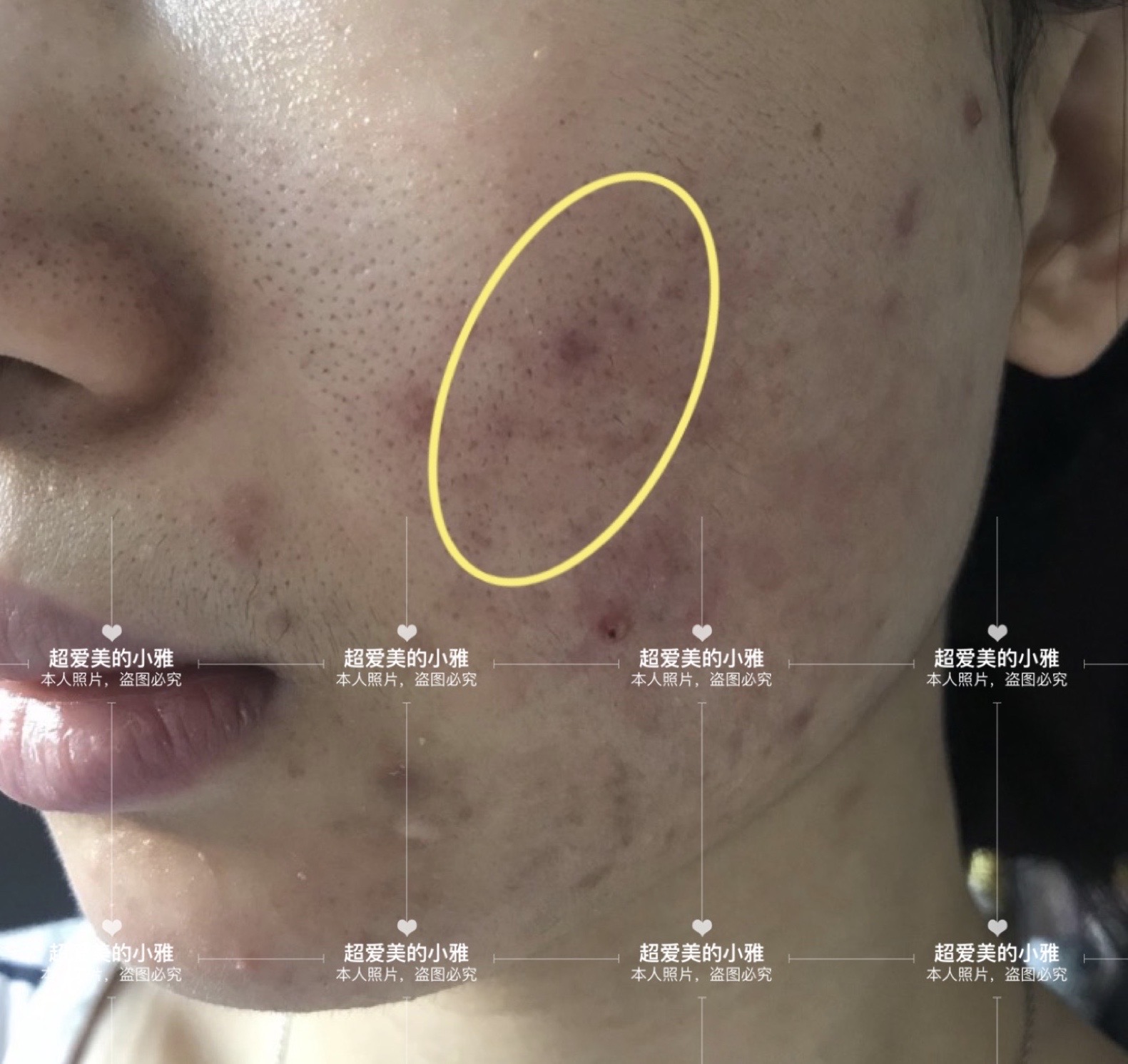 战胜痘痘重拾自信,对抗痘痘常用药膏