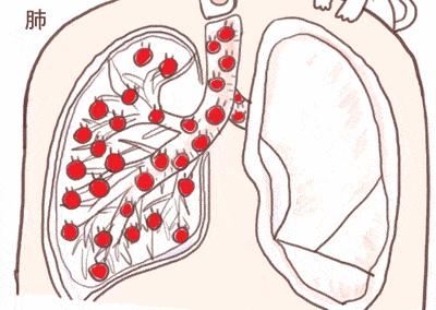 喉咙老有痰健脾祛湿化痰的中成药,喉咙痰多中医怎么祛痰