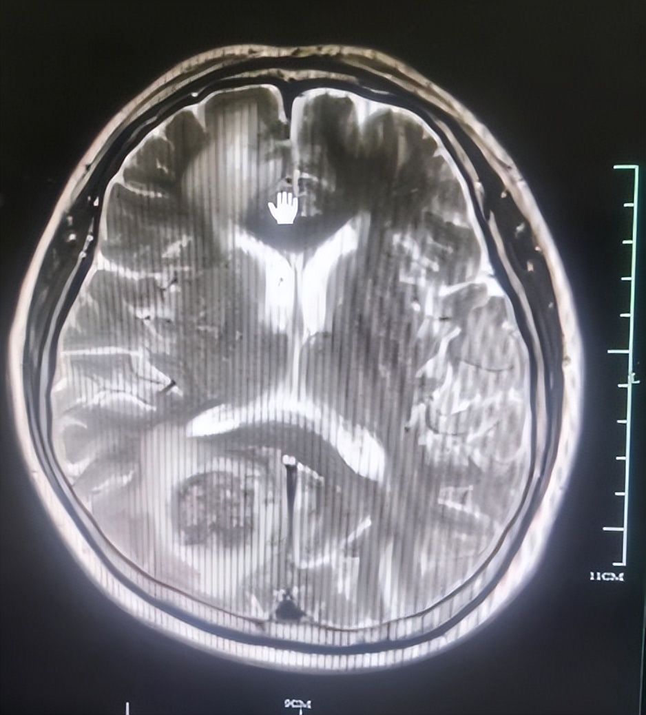 直肠癌晚期转移了好治疗吗,直肠癌晚期肺部转移了还能活多久