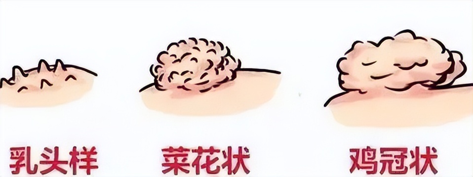 湿疣梅毒淋病怎么引起的,淋病梅毒湿疣症状