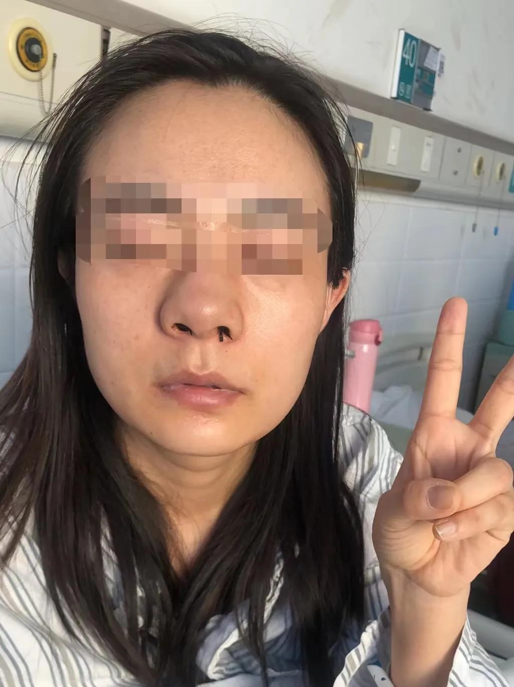 病号服全部被冷汗打湿，我在搀扶下坚持去问医生鼻子有没有变塌