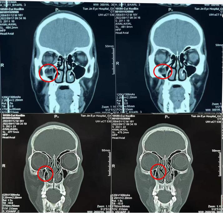 眼部痉挛手术成功率有多少,眼睑痉挛手术能彻底治好吗