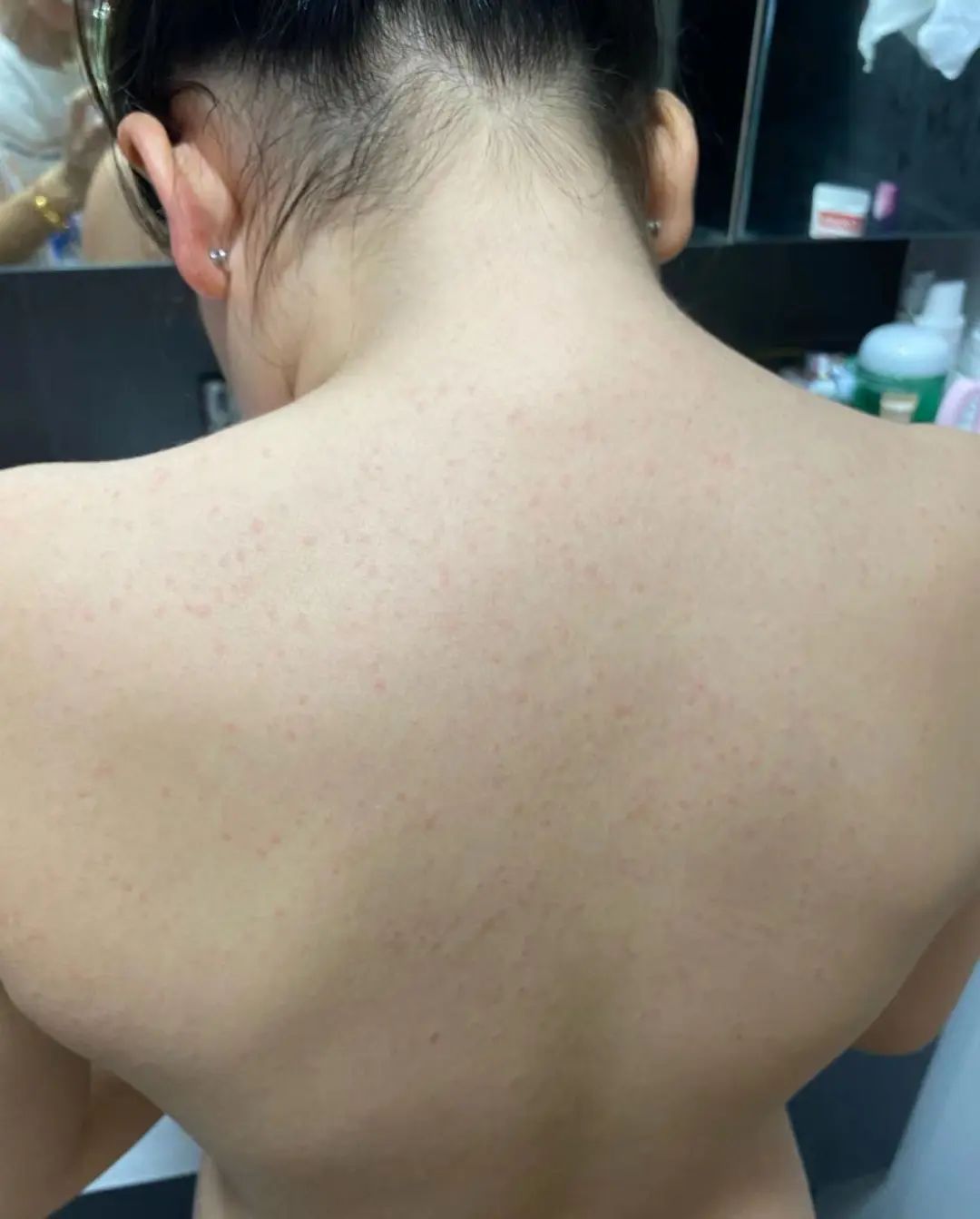 “娃全身红疹，被新加坡医生要求全麻开刀！我该怎么办？”