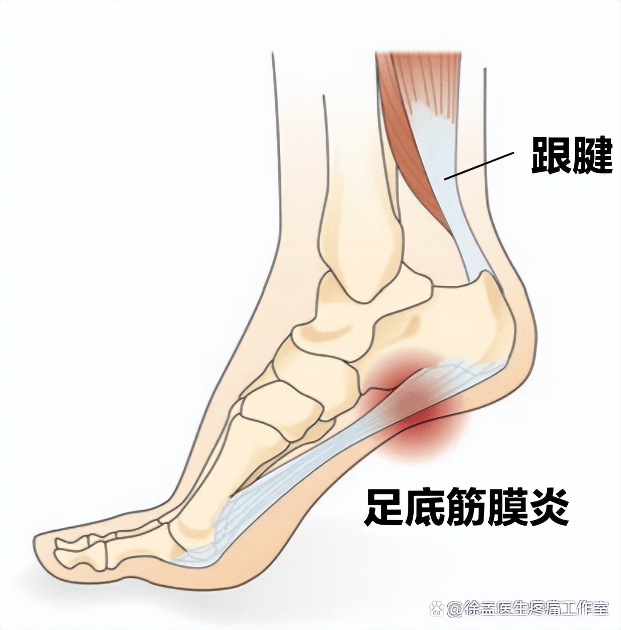 足底筋膜炎可以忍着吗,足底筋膜炎骨刺怎么治疗