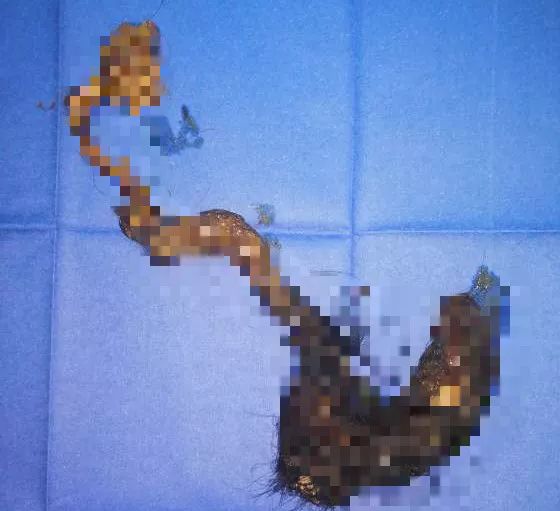 误吞牙签怎么办,少年误吞牙签一个小妙招