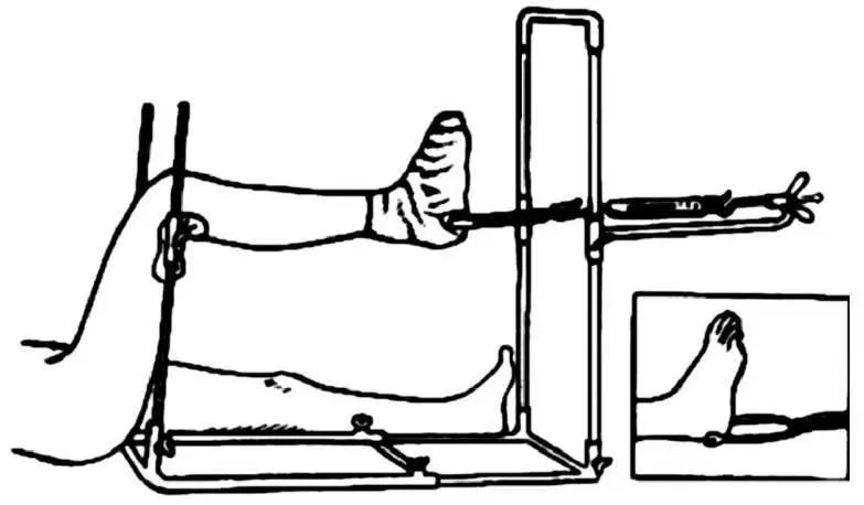 胫腓骨骨折护理方案难点,左胫腓骨骨折多久可以下地