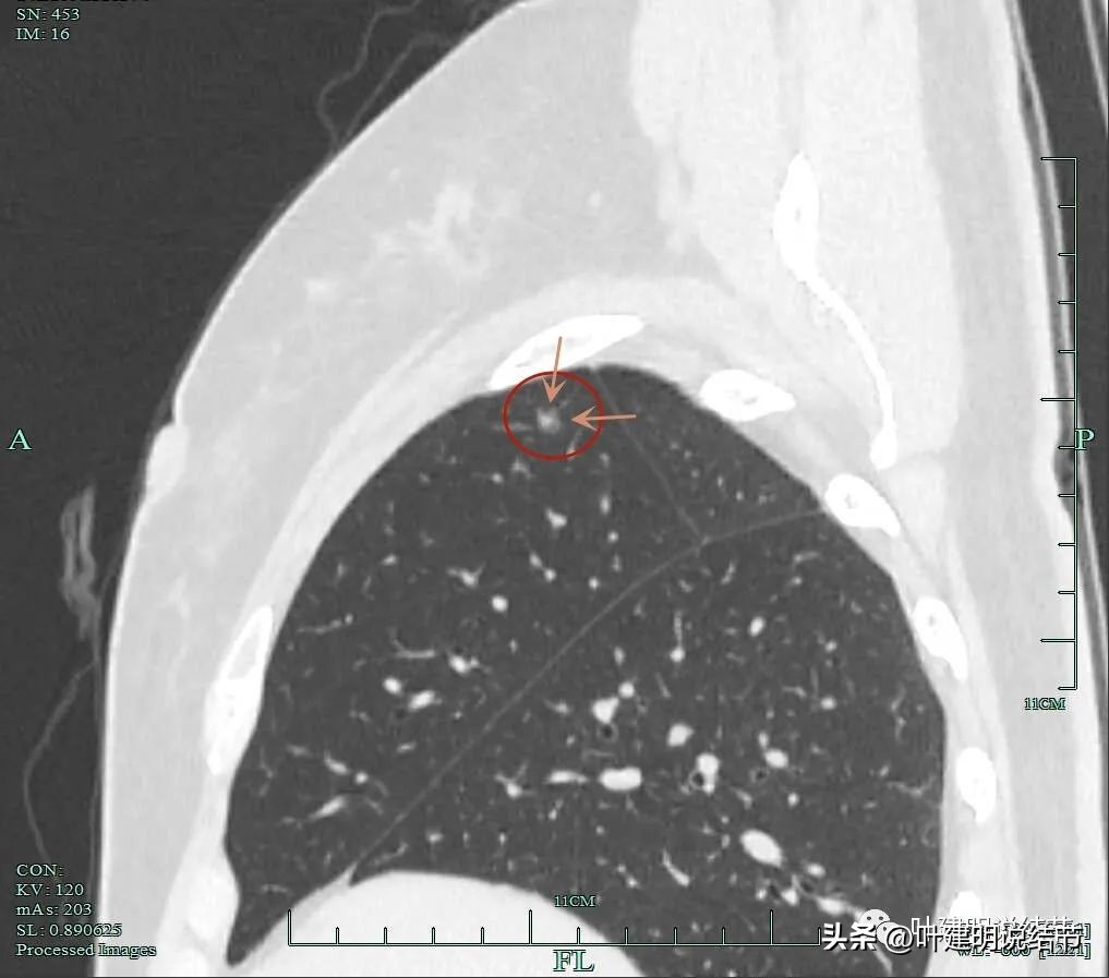肺癌右中上叶全切,右肺上叶小结节查出是癌怎么办