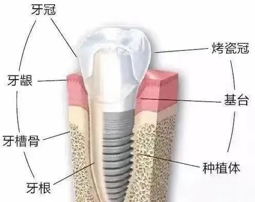 全瓷牙和烤瓷牙哪个质量好一点,全瓷牙和烤瓷牙的图片对比