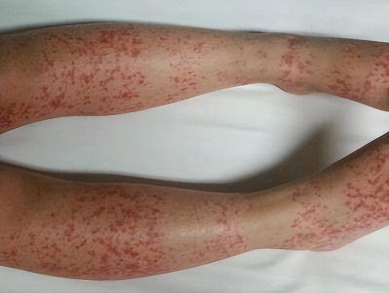 名医过敏性紫癜用药经验,过敏性紫癜早期中医辨证论治