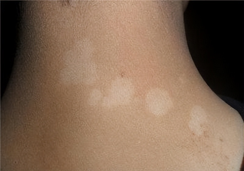 小面积白斑怎么复色,小面积白斑用什么药