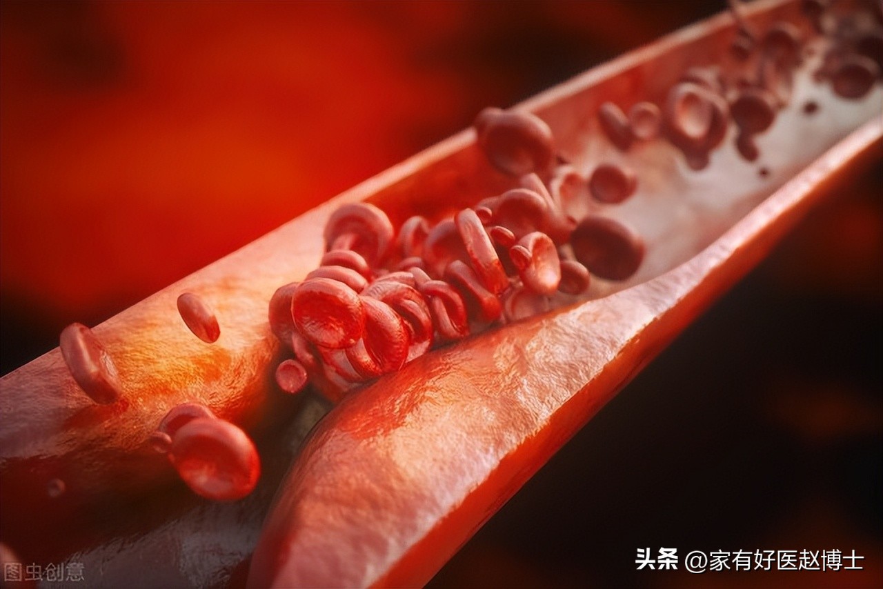 有动脉斑块必须要吃阿司匹林多久,有颈动脉斑块吃阿司匹林可以吗