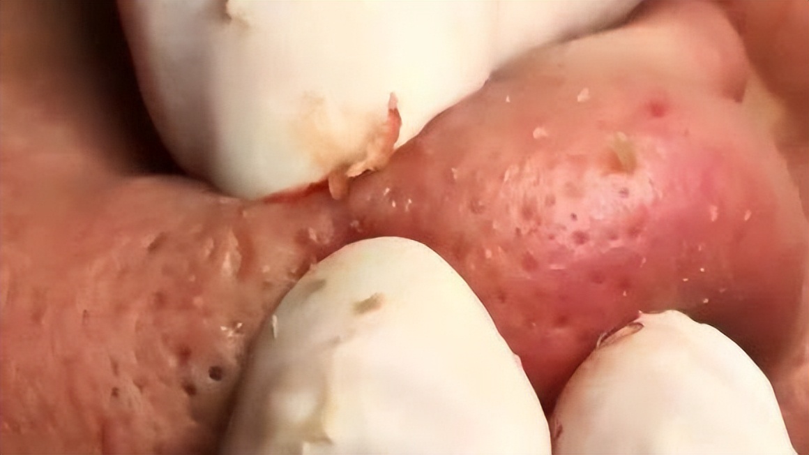 眉心鼻翼和下巴长粉刺为什么,鼻头上起粉刺什么原因引起的图片