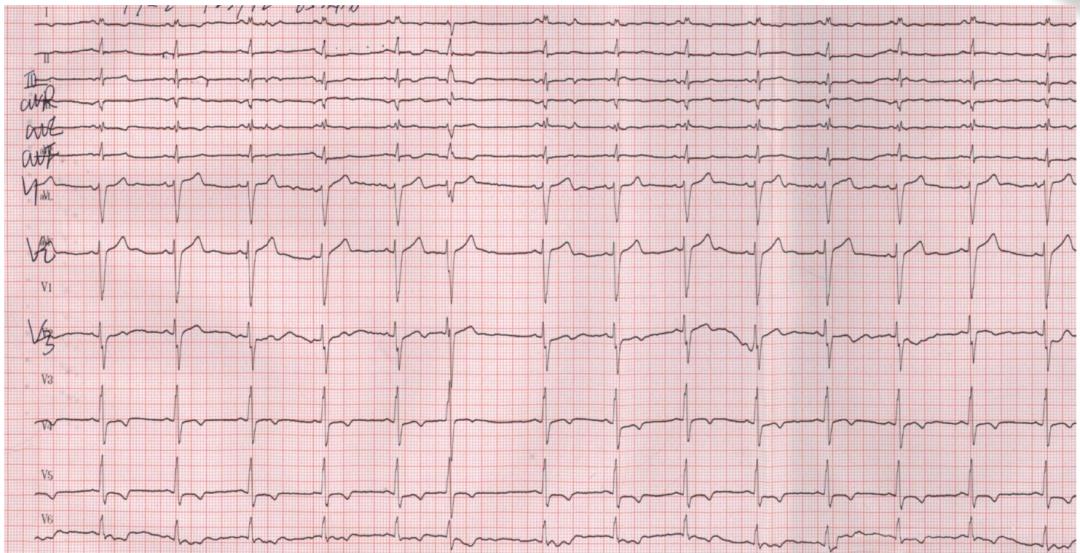 心电图qrs时限超宽是什么引起的,心电图qrs波呈m型见于什么疾病
