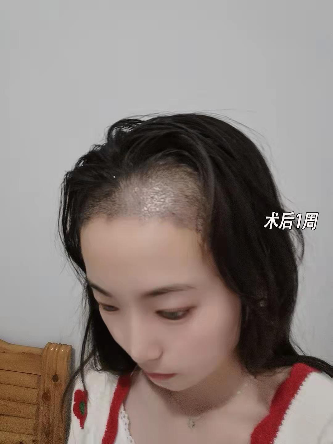 恒美植发需要多少钱,恒美植发跟碧莲盛植发