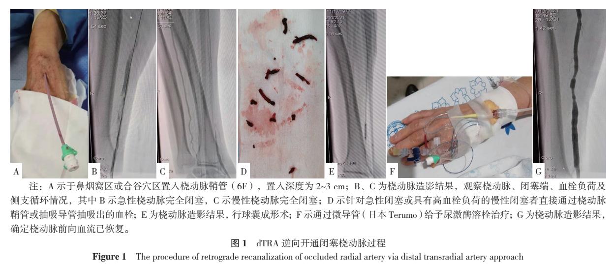 远端桡动脉穿刺术新技术,有关桡动脉的研究