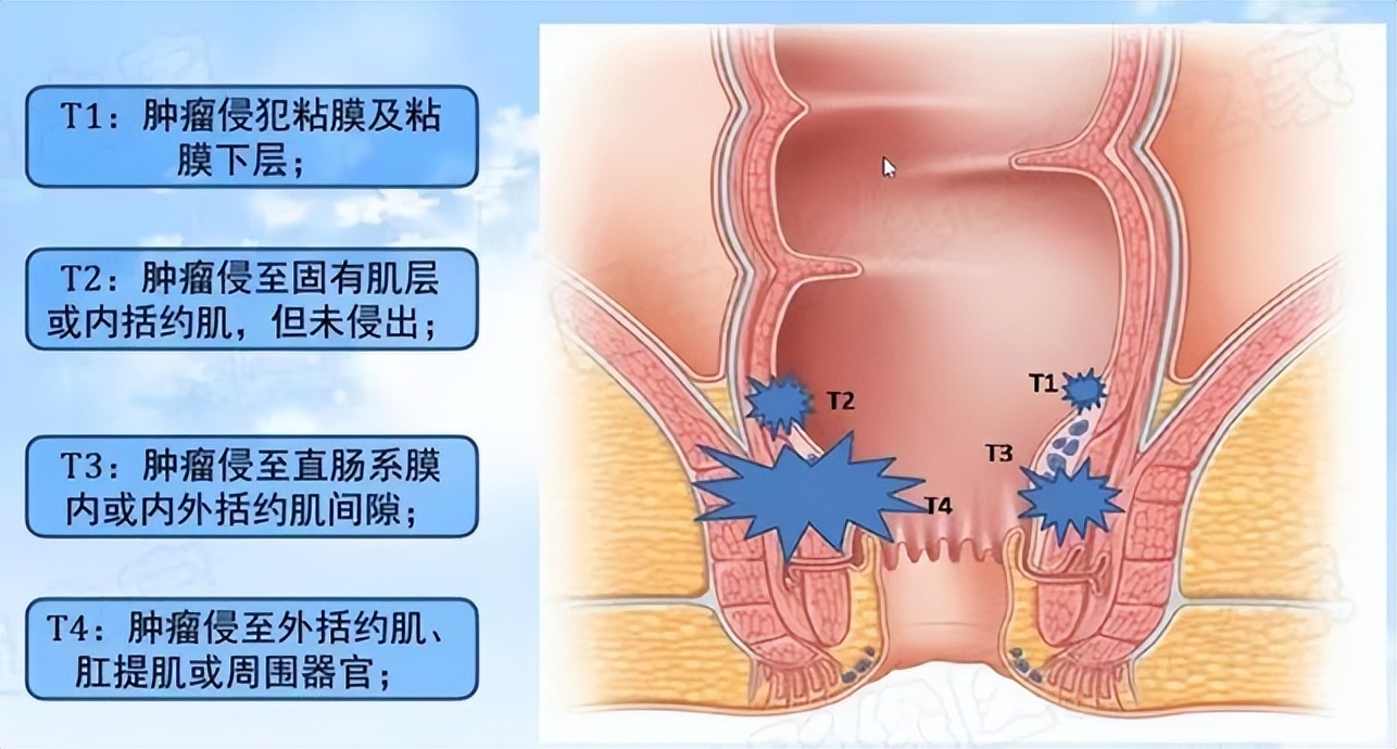 大肠癌科普知识(四十四)大肠癌必做检查之直肠MRI的必要性