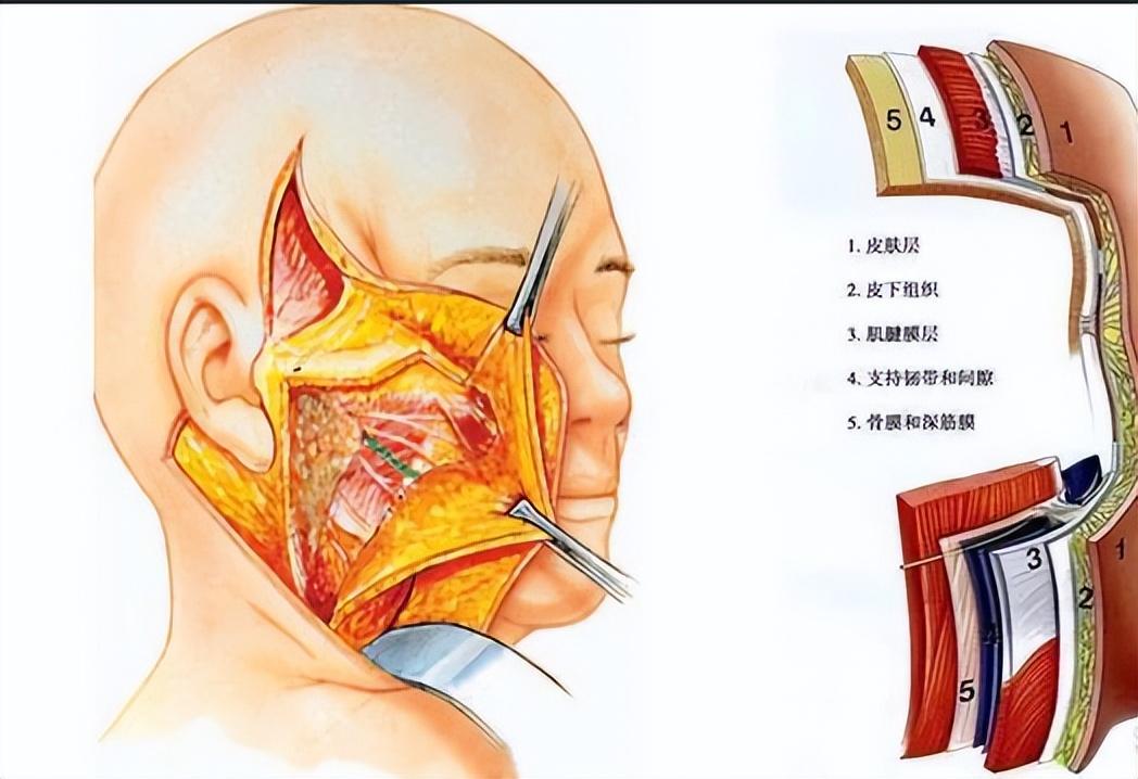 做个面部拉皮手术要多少钱啊,小拉皮手术后多久能恢复自然