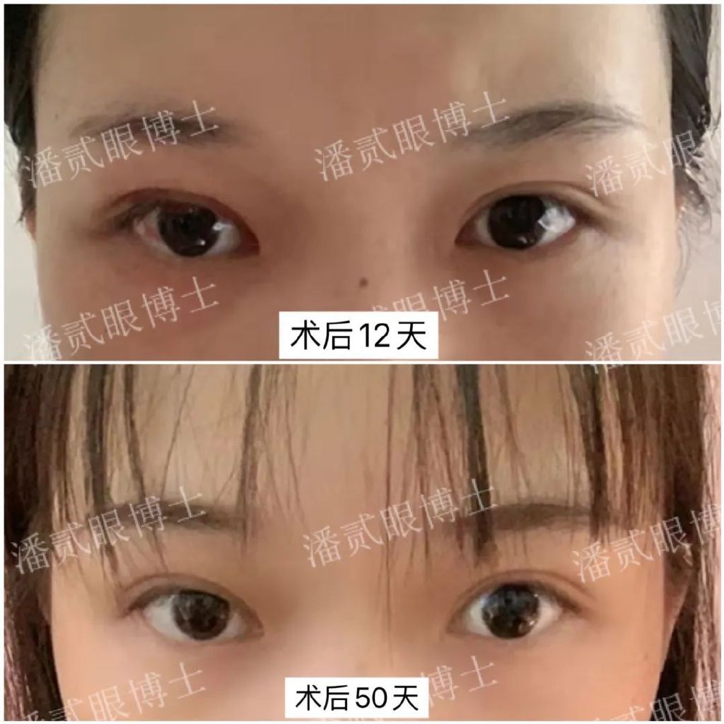 术后（重度上睑下垂）出现结膜脱垂怎么办？