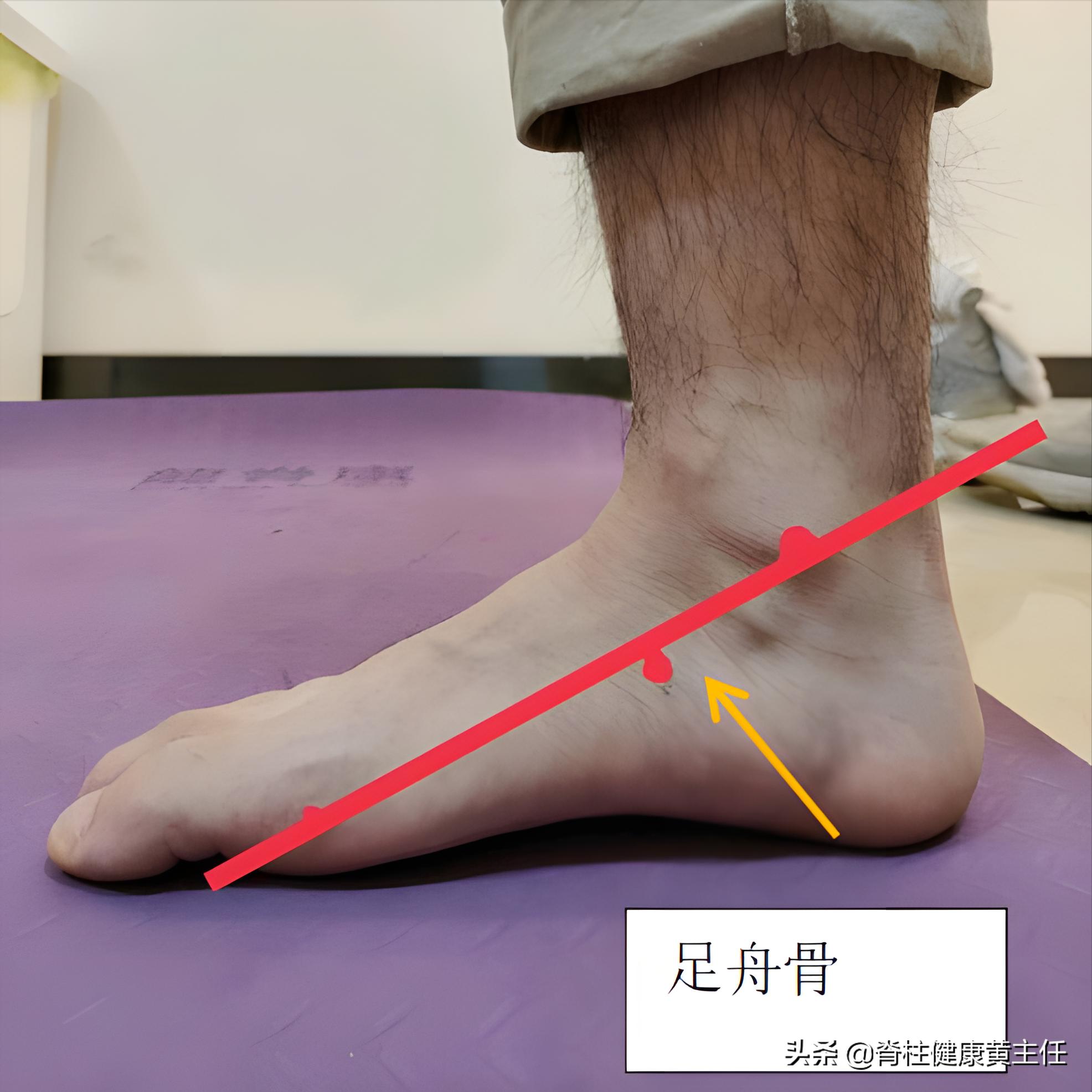 怎样判断自己有没有扁平足,怎么判断自己扁平足严不严重