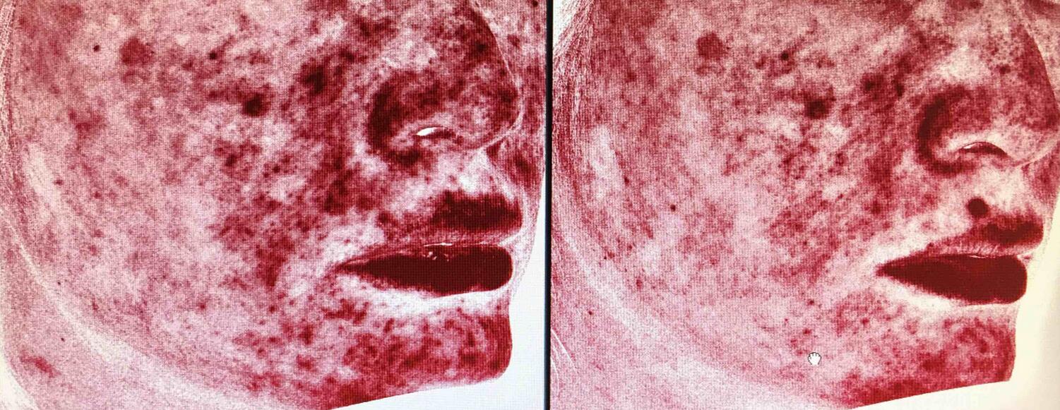 脸遇热发红、皮肤敏感、脸上长痘，原来是玫瑰*疮痤**在作怪！