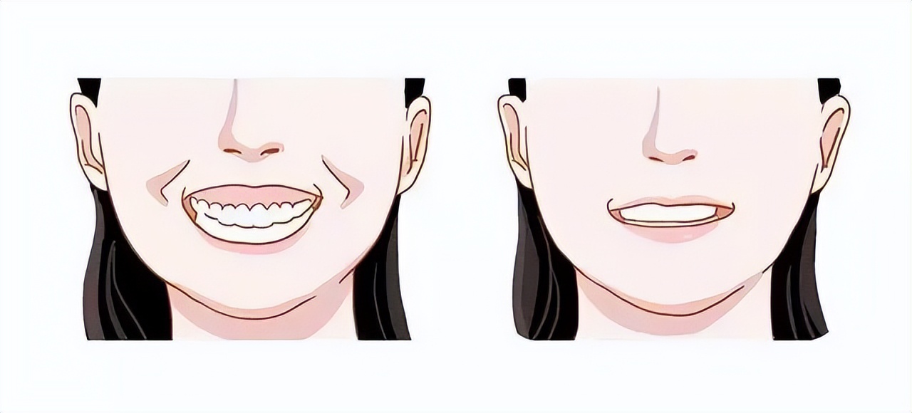 深覆颌深覆盖什么情况下不用矫正,深覆盖和深覆颌哪个严重些