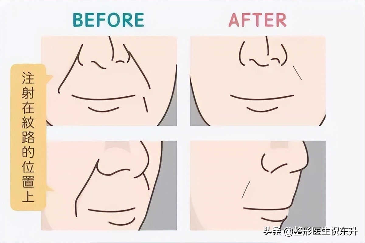 口角纹和法令纹去除方法,法令纹嘴角纹去除最好的方法