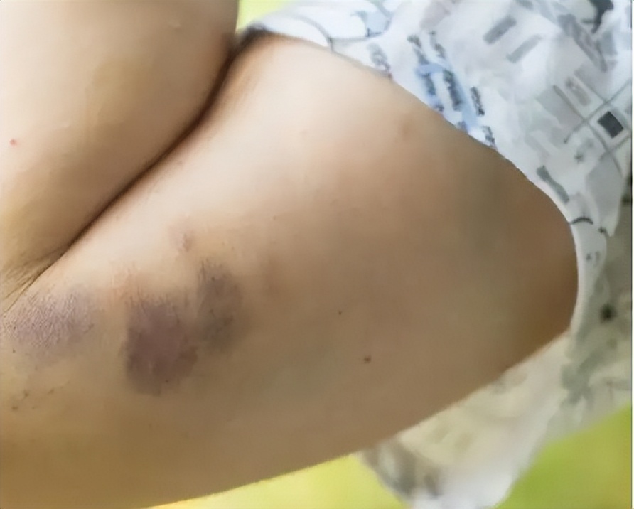 筋膜枪对小孩有用吗,医生不建议使用筋膜枪吗