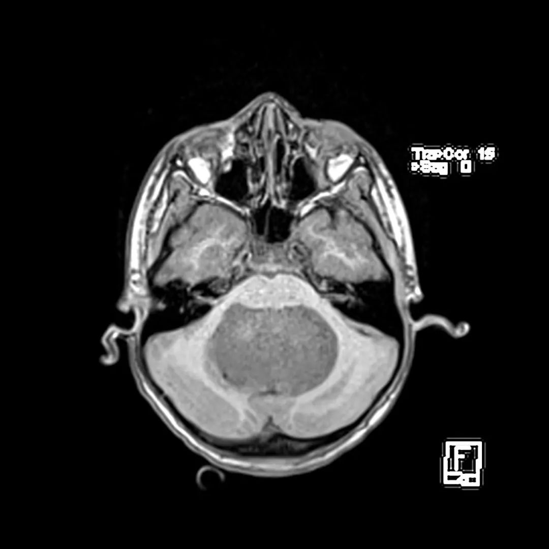 经典型髓母细胞瘤,影像诊断图片解析