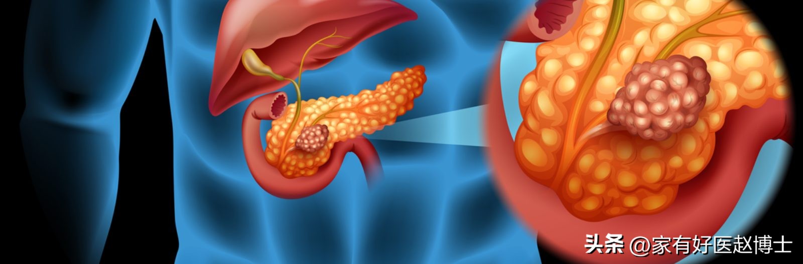 胰岛细胞治疗糖尿病最新方法,糖尿病患者保护心血管