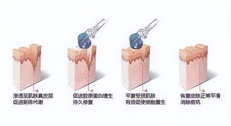 微针祛斑用什么药导入,涂抹式祛斑祛痣