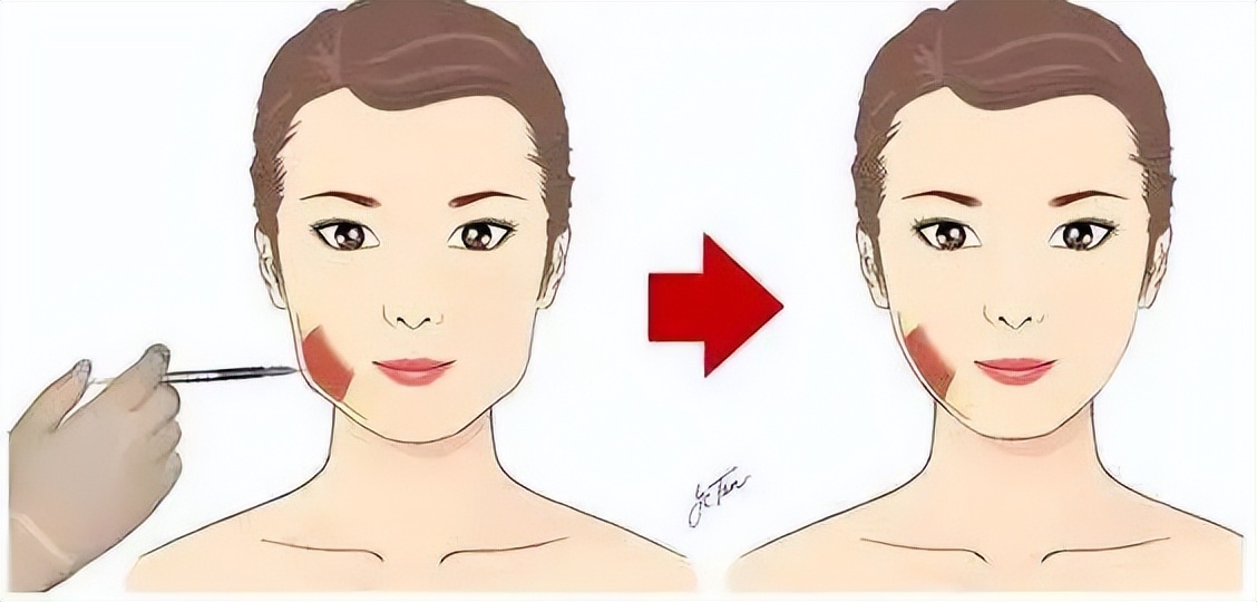 咬肌切除手术和瘦脸针,瘦脸针和咬肌切除该怎么选