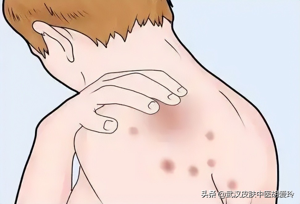 皮肤圆圈形红斑脱皮,身上起红色斑块中间脱皮