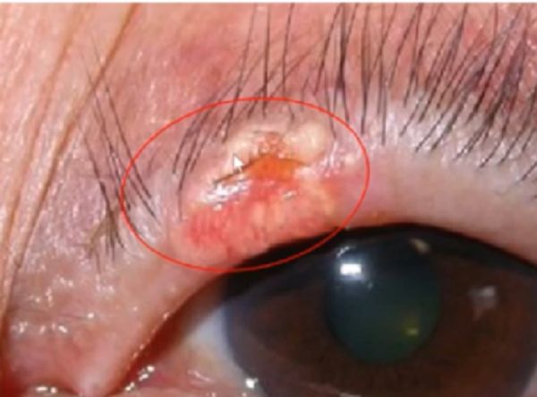 眼皮长了个小疙瘩怎么去掉,右眼皮上长了个小疙瘩预兆