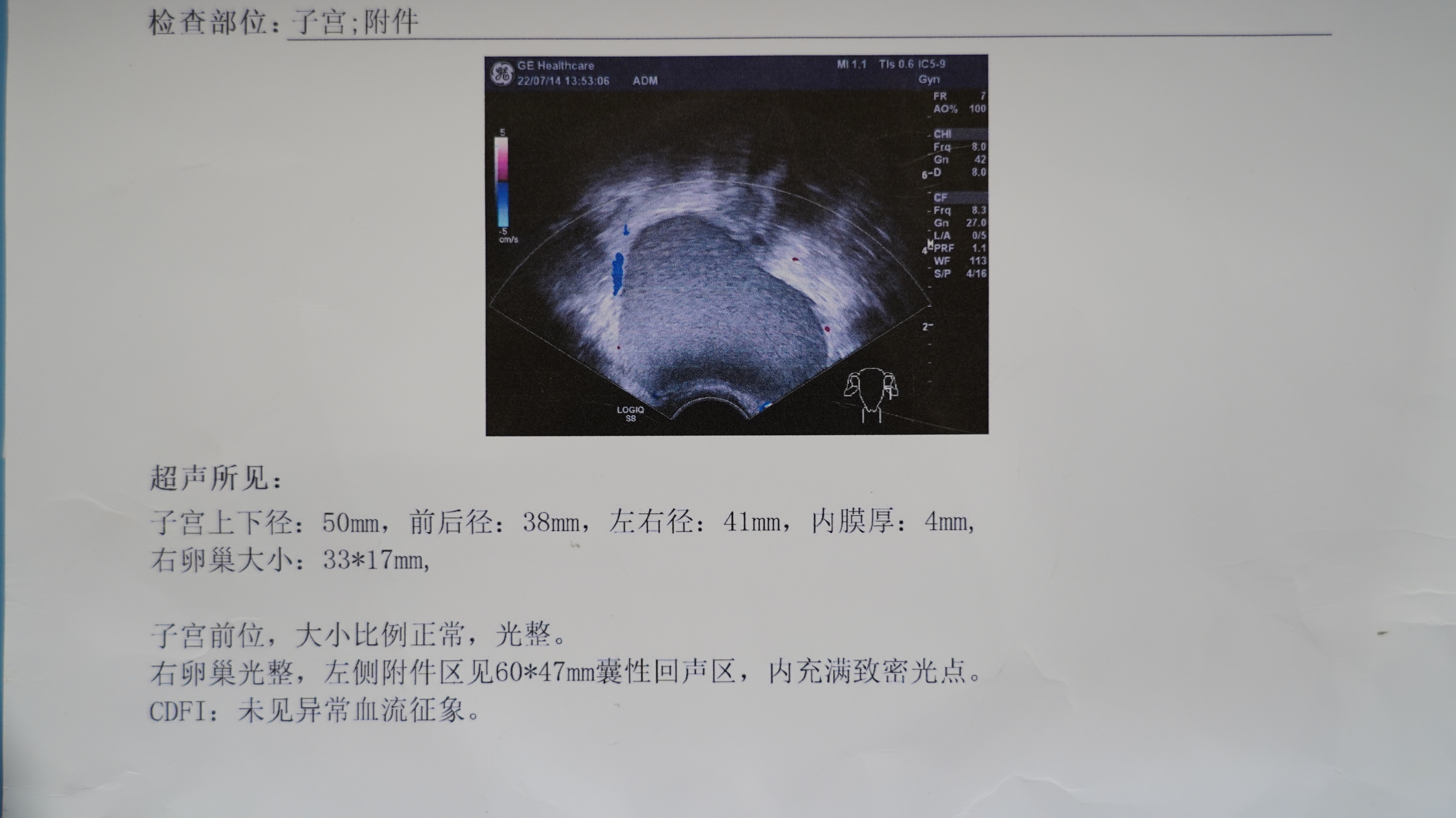 20岁查出巧克力囊肿，腹腔镜微创切除