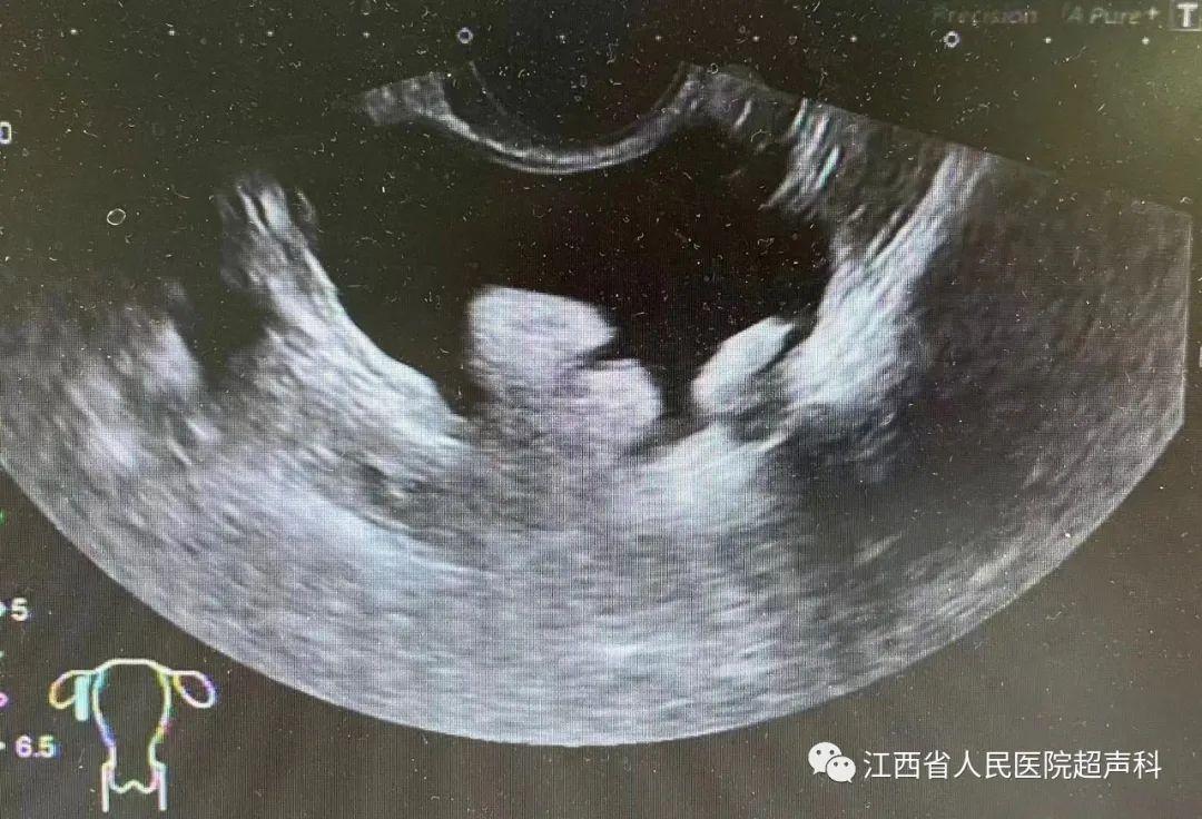 仁医科普|卵巢囊肿是什么？该如何处理？