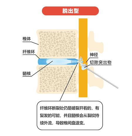 腰椎滑脱手术治疗风险大吗,腰5骶1腰椎滑脱怎么治疗