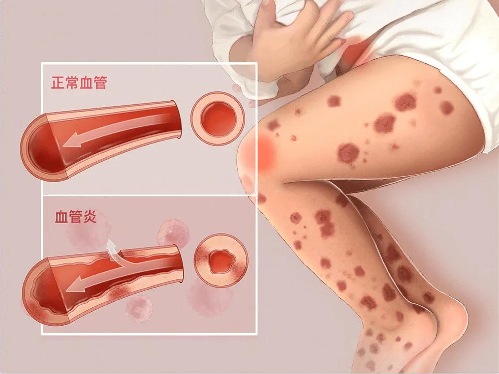 治疗过敏性紫癜有特效药吗,治疗过敏性紫癜一般用什么激素